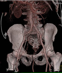 Stent in Right Femoral Vein - CTisus CT Scan