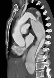 Type B Dissection With Active Extravasation Into Wall of Aorta - CTisus CT Scan