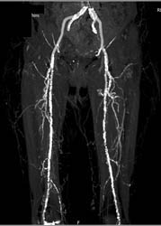 Significant Peripheral Vascular Disease (PVD) - CTisus CT Scan