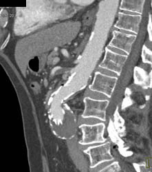 Abdominal Aortic Aneurysm (AAA) With Endostent - CTisus CT Scan