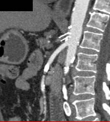 Thrombosis of Celiac Artery Stent - CTisus CT Scan