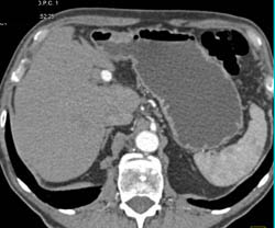 Hepatic Artery Aneurysm - CTisus CT Scan