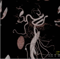 Hepatic Artery Aneurysm - CTisus CT Scan