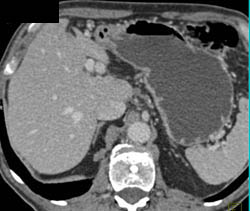 Hepatic Artery Aneurysm - CTisus CT Scan