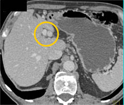 Hepatic Artery Aneurysm - CTisus CT Scan