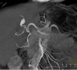 Hepatic Artery Aneurysm - CTisus CT Scan