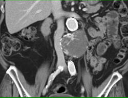 Endoleak With Active Extravasation - CTisus CT Scan