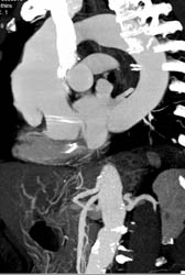 Ulceration in Ascending Aorta at Root - CTisus CT Scan