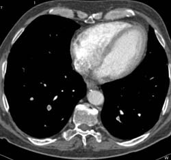 Pulmonary Embolism - CTisus CT Scan