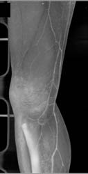 Trauma With Patent Popliteal Artery - CTisus CT Scan