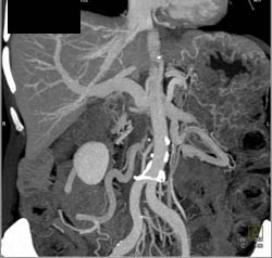 VRT Vs MIP in Collateral Flow - CTisus CT Scan