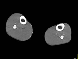 GSW to Calf Without Active Extravasation - CTisus CT Scan