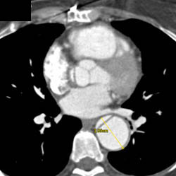 Type A Dissection Extends to Abdominal Aorta - CTisus CT Scan