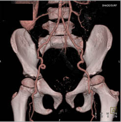 Ectatic Arteries in Form of Loeys-Deitz Syndrome - CTisus CT Scan