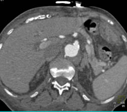 Ulcer in Abdominal Aorta - CTisus CT Scan