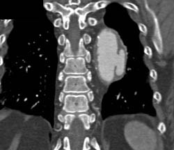 Ulceration of Descending Thoracic Aorta - CTisus CT Scan