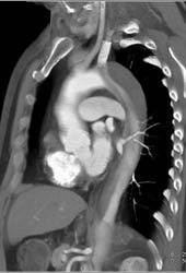 Type B Dissection - CTisus CT Scan