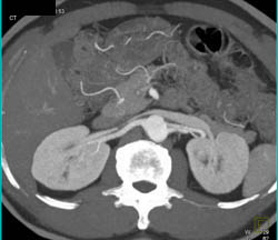 Dissection Into Renal Artery Not Seen on MIP Image - CTisus CT Scan