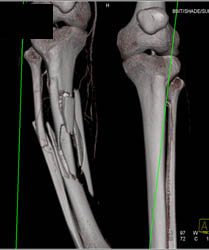 Tibial/fibular Fracture Without Vascular Injury - CTisus CT Scan