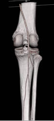 Normal Trifurcation of Vessels - CTisus CT Scan