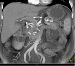 Median Arcuate Ligament Syndrome With Celiac Stenosis With Collaterals Off Gastroduodenal Artery (GDA) - CTisus CT Scan