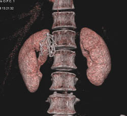 Inferior Vena Cava (IVC) Filter - CTisus CT Scan