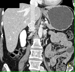 Inferior Vena Cava (IVC) Filter - CTisus CT Scan