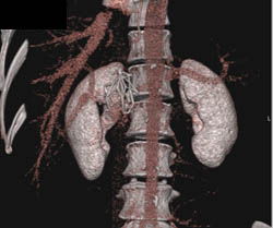 Inferior Vena Cava (IVC) Filter - CTisus CT Scan