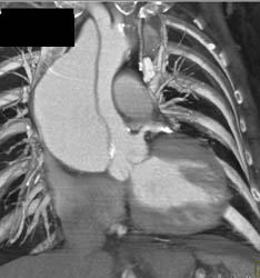 Type A Dissection - CTisus CT Scan