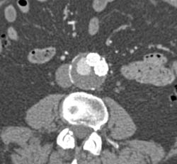 Endoleak - CTisus CT Scan