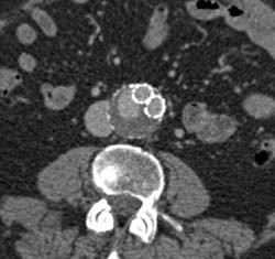 Endoleak - CTisus CT Scan