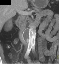 Endoleak - CTisus CT Scan