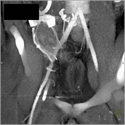 Iliac Artery Occlusion S/P Trauma - CTisus CT Scan