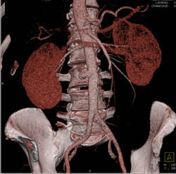 Focal Pseudoaneurysm of Aorta - CTisus CT Scan