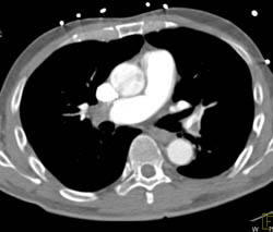 Huge Pulmonary Emboli - CTisus CT Scan