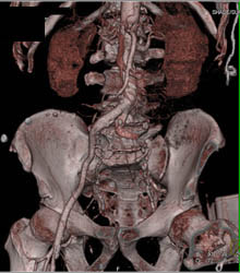 Occluded Left Common Iliac Artery Due to Clot in Aorta- Plus Pulmonary Embolism! - CTisus CT Scan