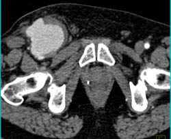 Pseudoaneurysm - CTisus CT Scan