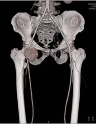 Pseudoaneurysm - CTisus CT Scan