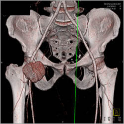 Pseudoaneurysm - CTisus CT Scan