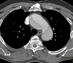 Type A Dissection Extends Into Iliacs - CTisus CT Scan