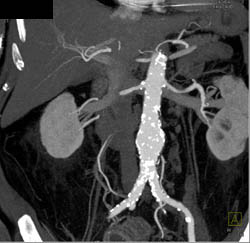 Abdominal Aortic Aneurysm (AAA) With Calcified Plaques in Various 3D Displays - CTisus CT Scan