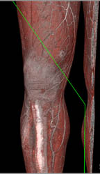 Stab Wound in Thigh With Active Bleed - CTisus CT Scan