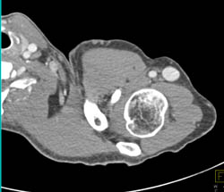 Av Fistulae- Patent - CTisus CT Scan