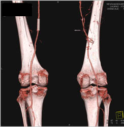 CTA Runoff With Patent Stent in SFA - CTisus CT Scan