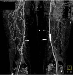 Runoff With Automatic Bone Editing and Peripheral Vascular Disease (PVD) - CTisus CT Scan