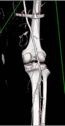 GSW to Knee With Active Bleed and Hematoma - CTisus CT Scan