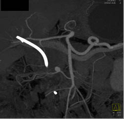 Aneurysm of Branch Vessel of SMA- Was Missed Initially on Axial Ct - CTisus CT Scan