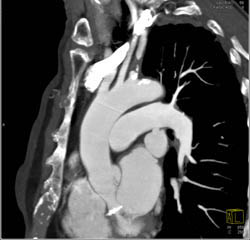 Diseased Left Subclavian Artery With Plaque - CTisus CT Scan