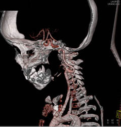 Ectatic Carotid Arteries in Loeys-Dietz Syndrome - CTisus CT Scan