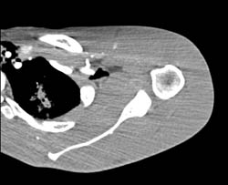 GSW to Shoulder Without Vascular Injury. Super Auto-edit With Potential Pitfall of Any Bone Removal Algorithm Illustrated - CTisus CT Scan